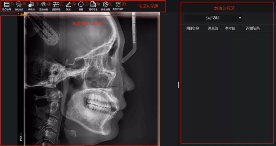 头影测量 | 首发解读eBrace透明软件医生端升级功能